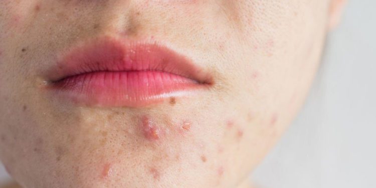 pimples acne