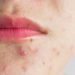 pimples acne