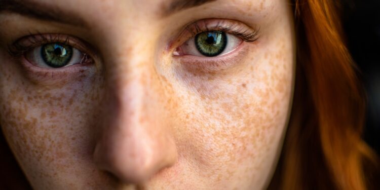 types of acne - 4 Different Types of Acne and How to Treat Them