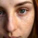 types of acne - 4 Different Types of Acne and How to Treat Them