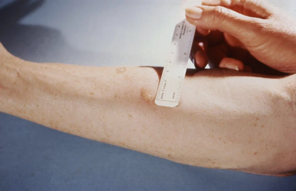 Why Standard Allergy Testing Misses This - signs of histamine intolerance in women