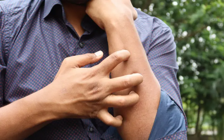 Perimenopause skin itching: a man in a blue shirt scratching his arm outdoors, highlighting skin irritation